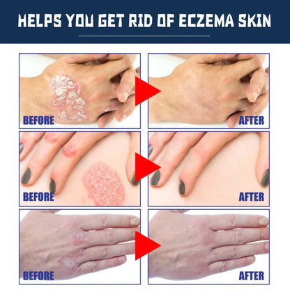 Sotuh Moon Psoriasis Relief Spray ( BUY 1 GET 1 FREE )