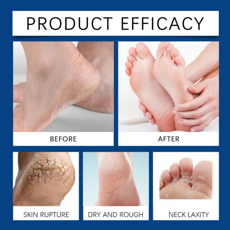 ✨ South Moon Foot Callus Remover Gel ✨ ( BUY 1 GET 1 FREE )